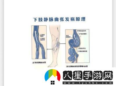 日系裸妝風(fēng)格與女士靜脈曲張成因詳解